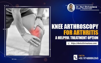 Knee Arthroscopy for Arthritis: A Helpful Treatment Option